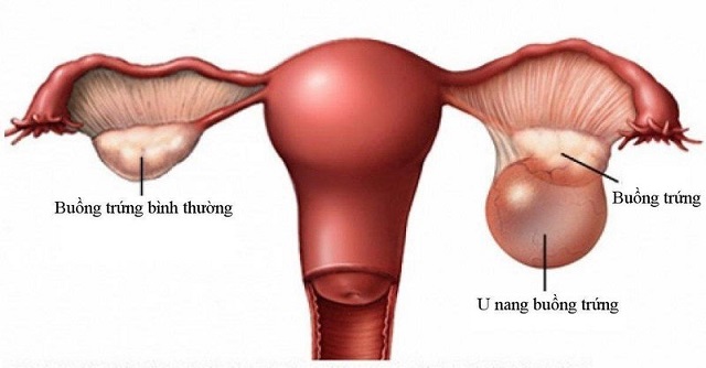 Trễ kinh và  chướng bụng do bị u nang buồng trứng