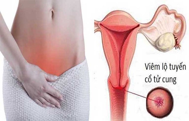 Viêm lộ tuyến cổ tử cung gây nhiều biến chứng nguy hiểm