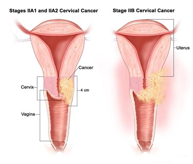 Nếu dùng quá lâu thuốc hàng ngày có thể làm tăng cao nguy cơ ung thư cổ tử cung ở phụ nữ.